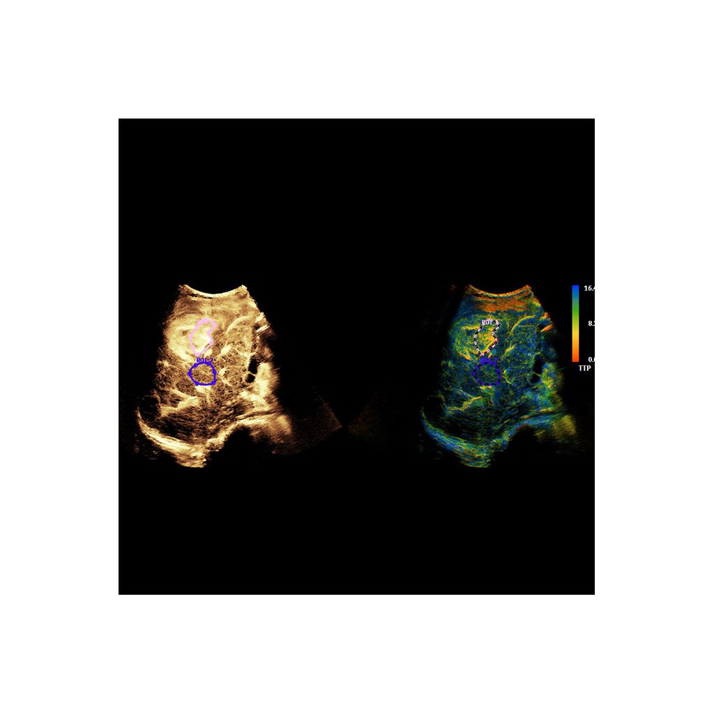 Super Res MVI Pro* TTP clinical image showing ROI Quantification of liver lesions 