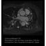 Coronary Acquisition thumbnail