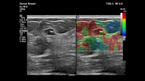 Breast clip with Elasto Strain comparison on eL18-4 transducer