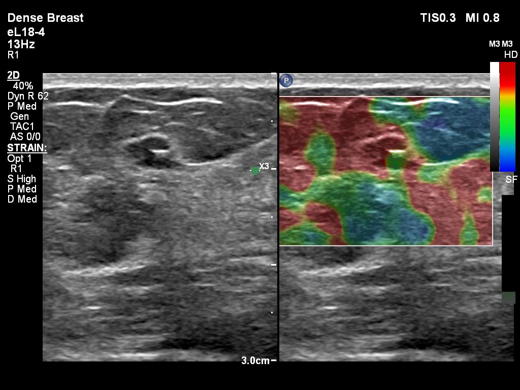 Breast clip with Elasto Strain comparison on eL18-4 transducer