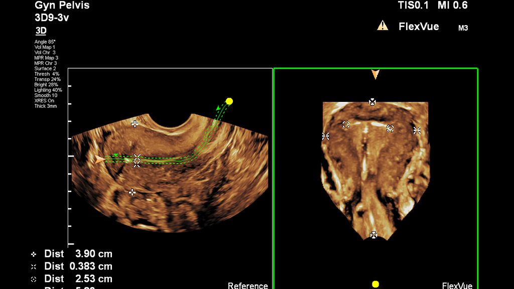 Screen capture of pelvic image with FlexVue measurements