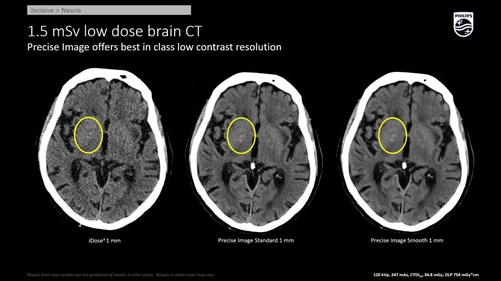 Incisive CT Neuro - Neuro Grey White Improved LCD