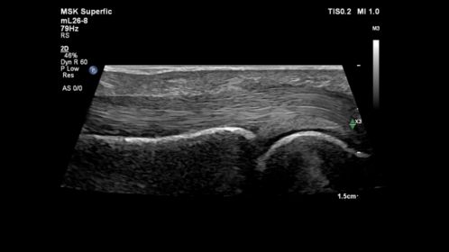 mL26-8 MSK Flexor Tendon