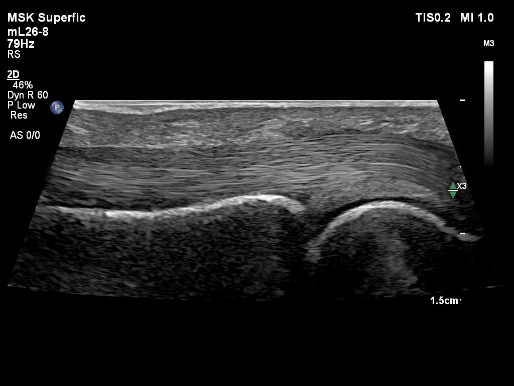 mL26-8 finger tendon
