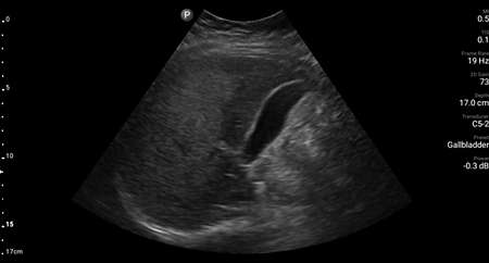 Liver ultrasound demonstrating fatty infiltration shown using C5-2 transducer.