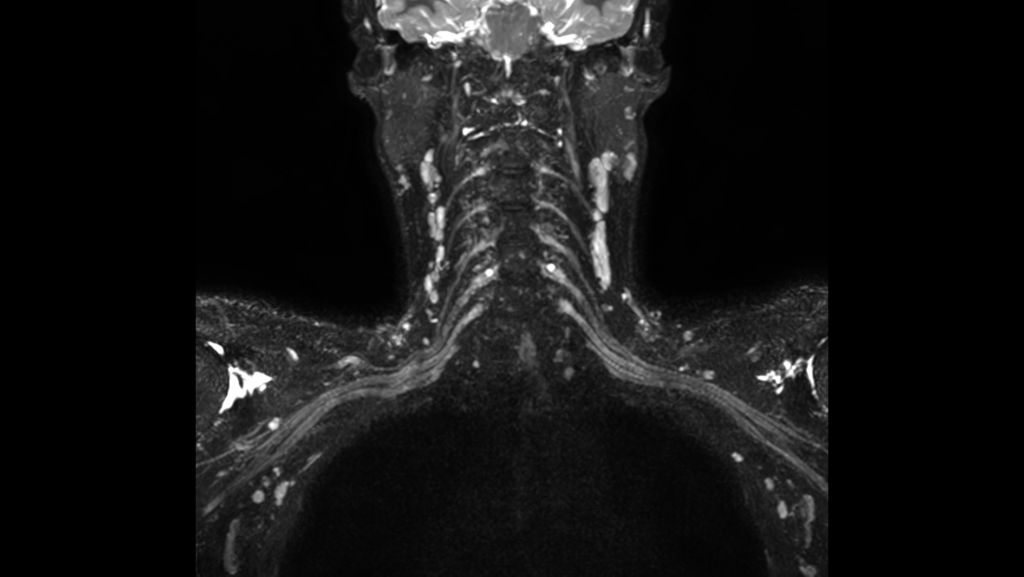 3D NerveVIEW (oblique reformat)