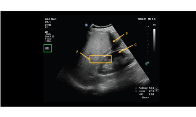 HRI image showing the placement of first ROI in the kidney and second ROI in the liver