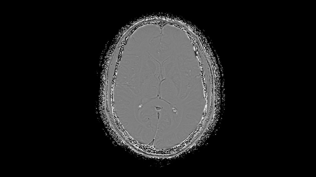 3D SWI (Phase) clinical image of the brain