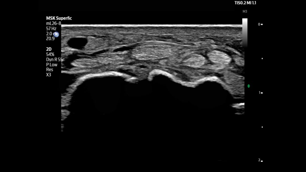 Median nerve shown using mL26-8 transducer on Flash 5100 POC.