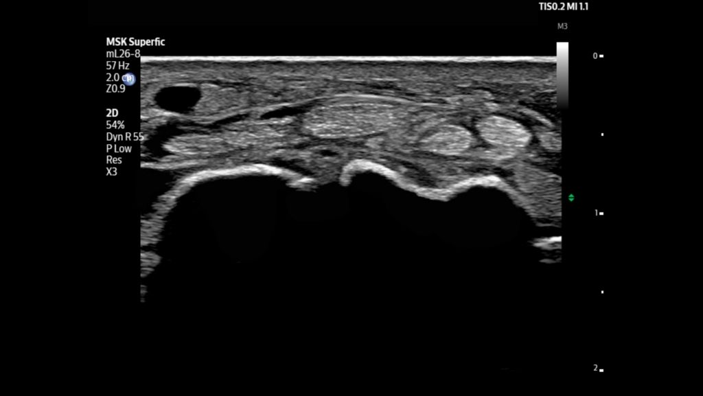 Median nerve shown using mL26-8 transducer.