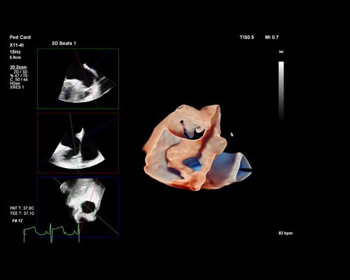 X11-4t Mini 3D TEE, pediatric cardiology LAA, echo