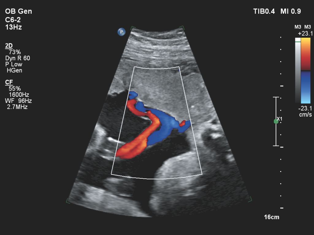 Affiniti 30 ultrasound clinical image obstetric