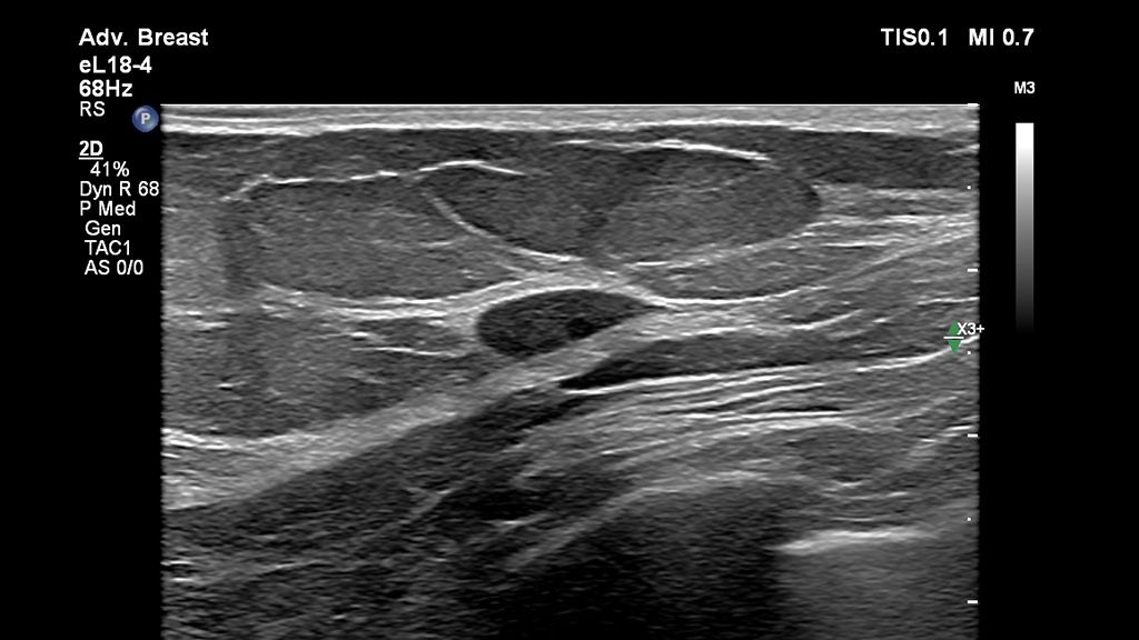 Clinical image using EPIQ Elite and eL18-4 transducer to show breast adenocarcinoma