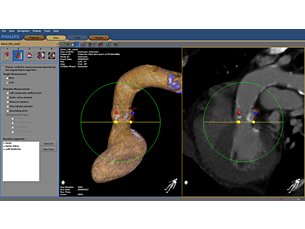 HeartNavigator Планирование и навигация при установке аортального клапана