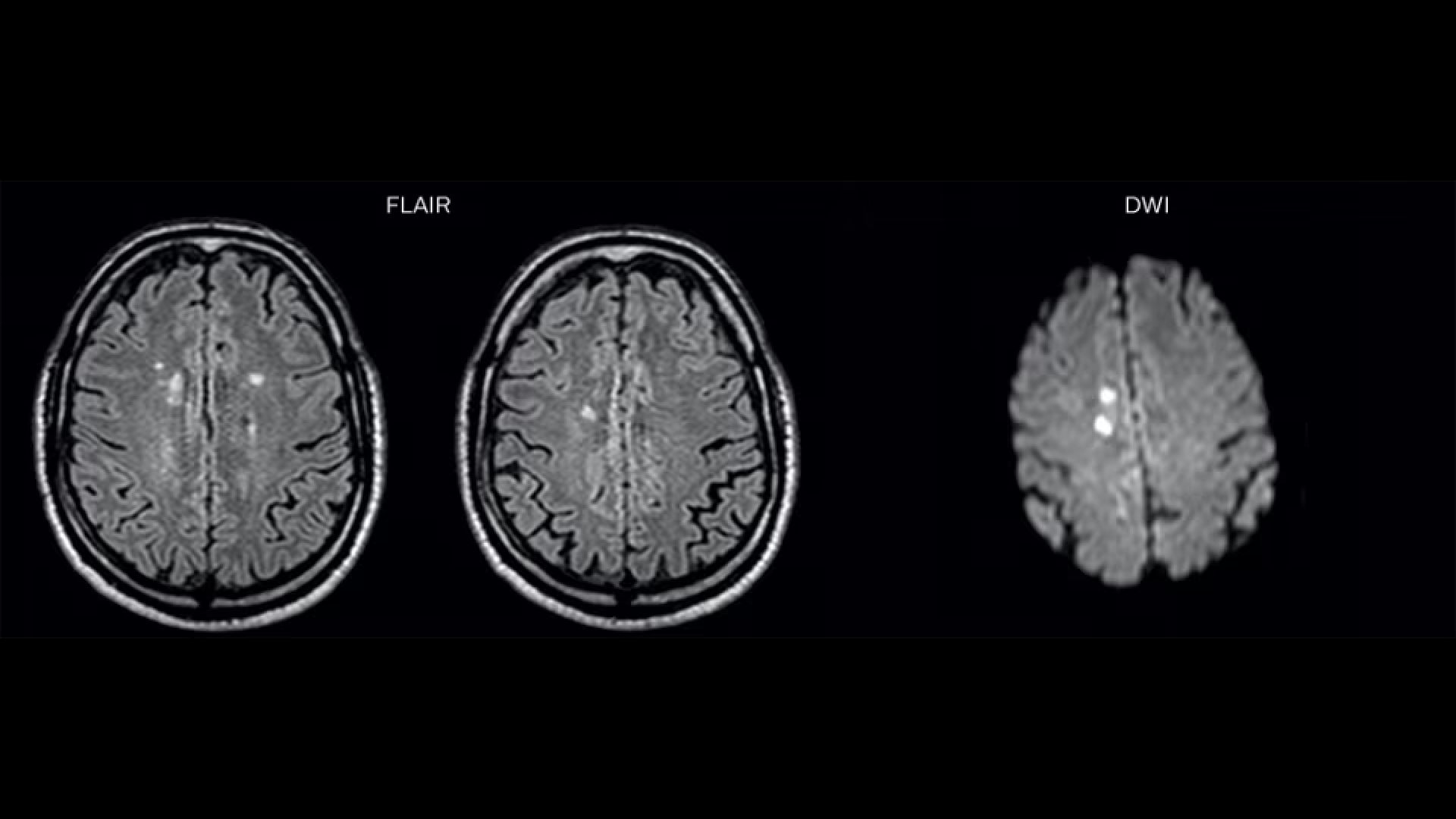 FLAIR images and DWI image with acute ischemic lesions