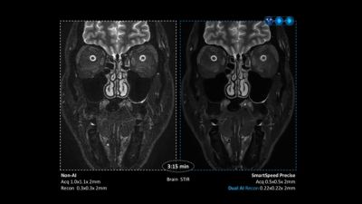 Comparison of brain MRI images using Philips SmartSpeed Precise Dual AI Recon versus non-AI acquisition