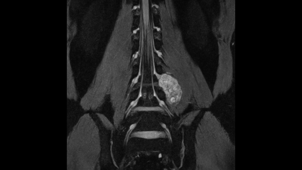 Coronal 3D T2w TFE Neurography (Schwannoma)
