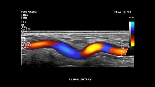 Ulnar artery
