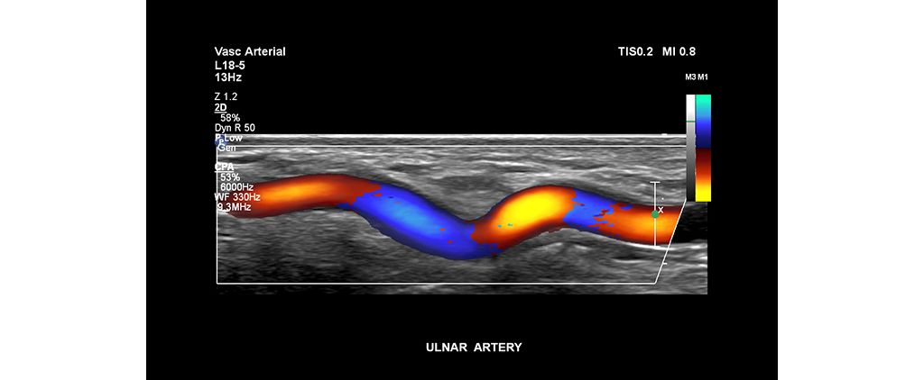 Ulnar artery