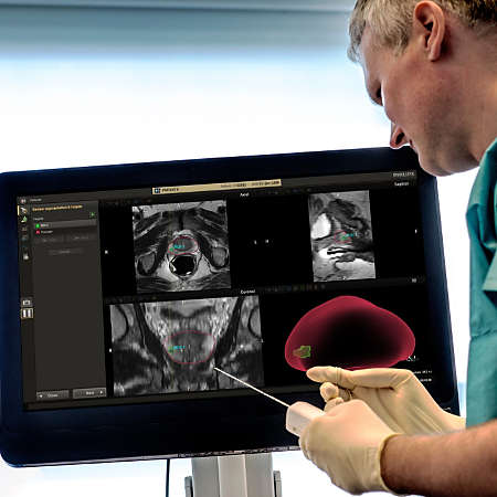 UroNav MR/US-guided prostate biopsies