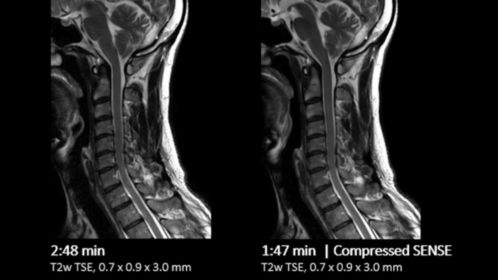 C-Spine comparison Compressed SENSE