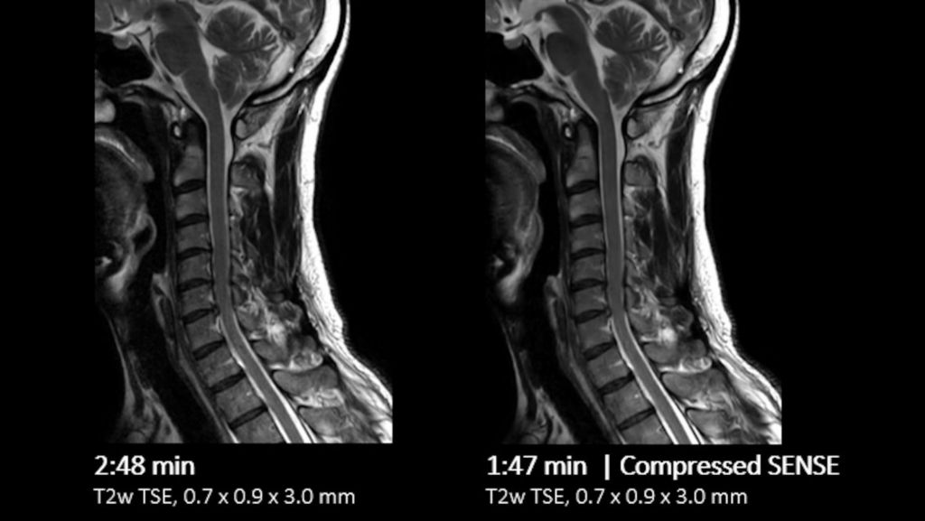 C-Spine comparison Compressed SENSE