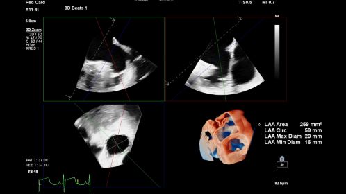 EPIQ CVx X11-4t for Pediatric cardiology