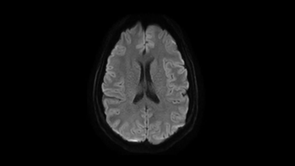 DWI b1000 clinical image of the brain