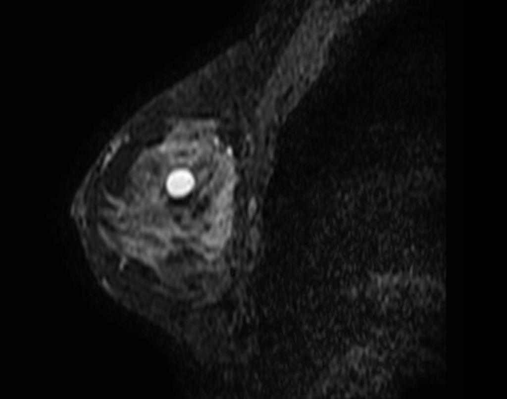 3D BreastVIEW - T2w SPAIR (sagittal reformat)
