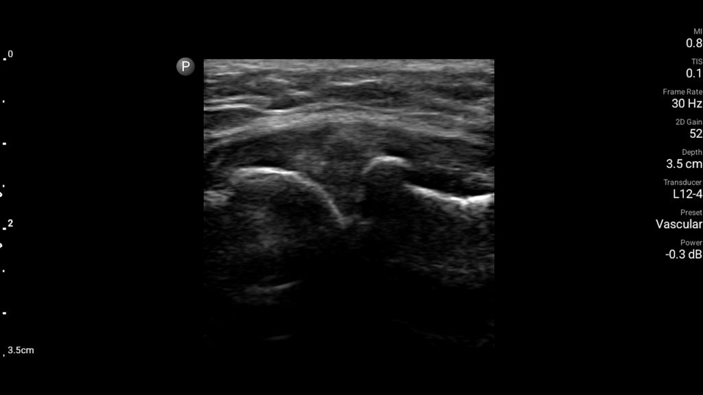 Lateral elbow image shown using L12-4 transducer on Lumify.
