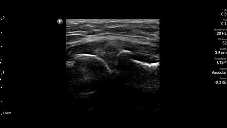 Lateral elbow image shown using L12-4 transducer.