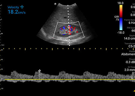 Arcuate artery in kidney with color and Pulsed Wave Doppler shown using C5-2 transducer.