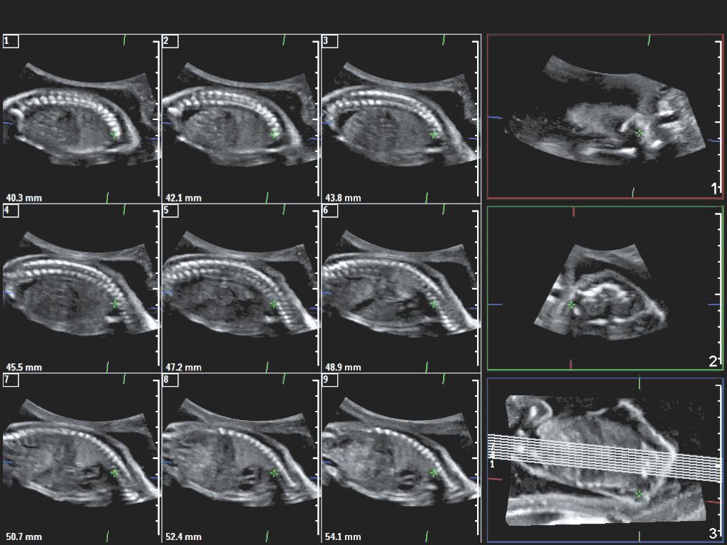 Affiniti 30 ultrasound clinical image 