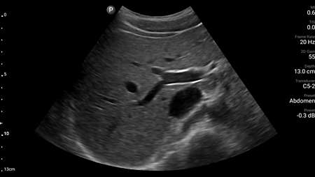 Transverse liver demonstrating portal vein with inferior vena cava shown using C5-2 transducer.