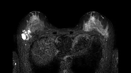 Breast Ca with T1 perfusion | Philips MR Body Map