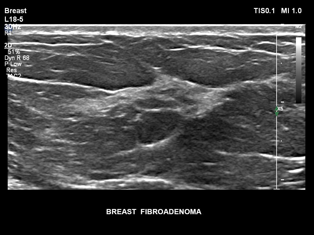 Breast fibroadenoma