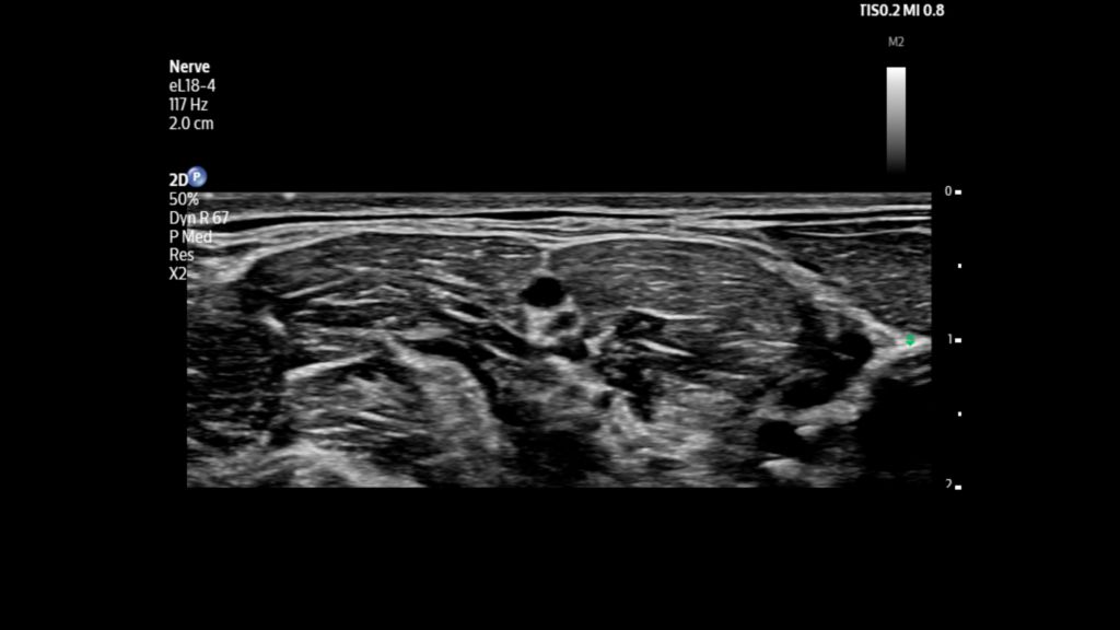 Brachial plexus nerve and interscalene muscles shown using eL18-4 transducer on Flash 5100 POC.