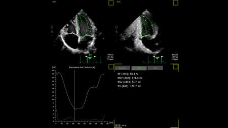 Flash Ultrasound System 5100 POC Pro: AutoStrain EF for confident cardiac assessment