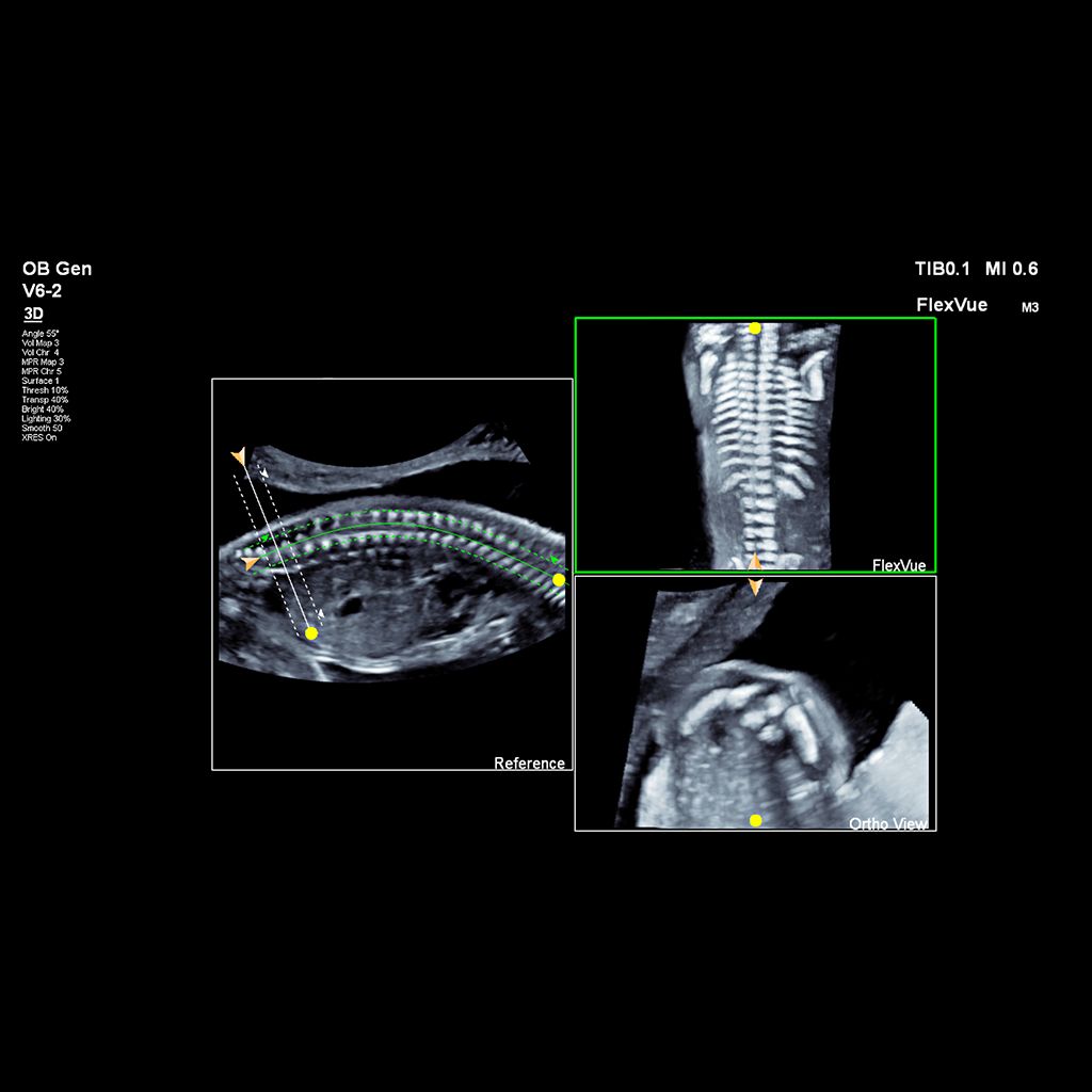 Ultrasound image of spine obtained via FlexVue with V6-2 transducer