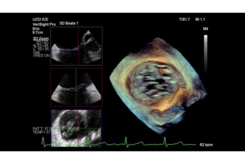 3D Volume of tricuspid valve with MultiVue