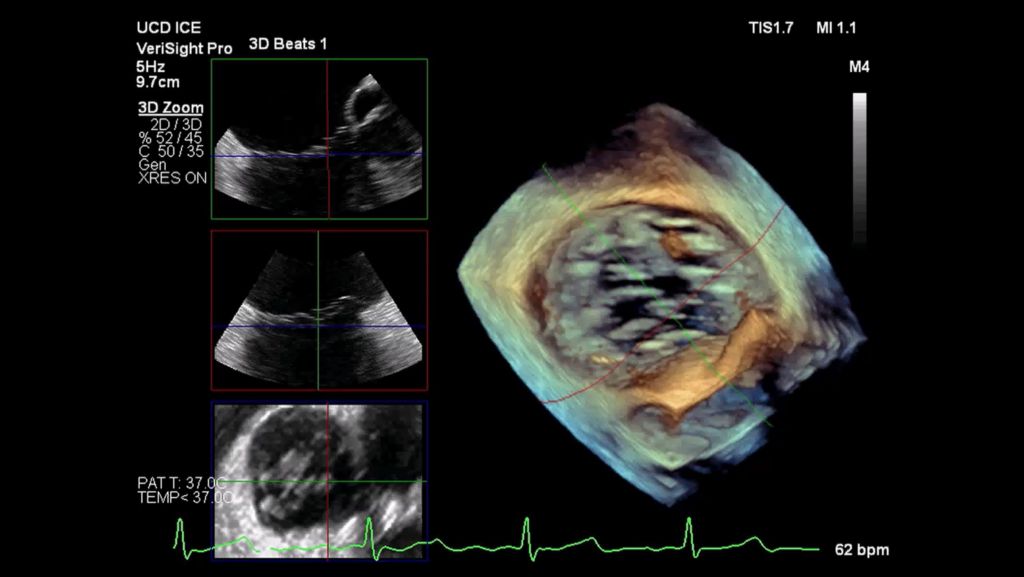 3D Volume of tricuspid valve with MultiVue