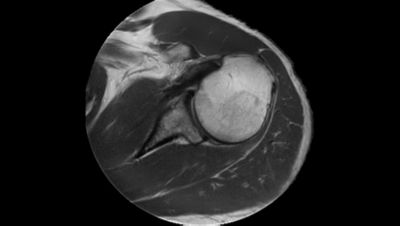 MRI