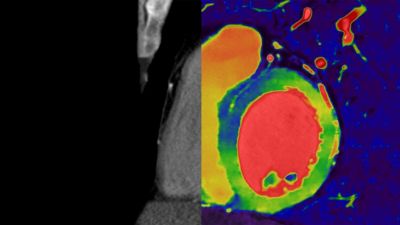 Confronto tra CT spettrale e CT tradizionale delle strutture cardiache.