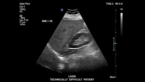 Liver technically difficult patient