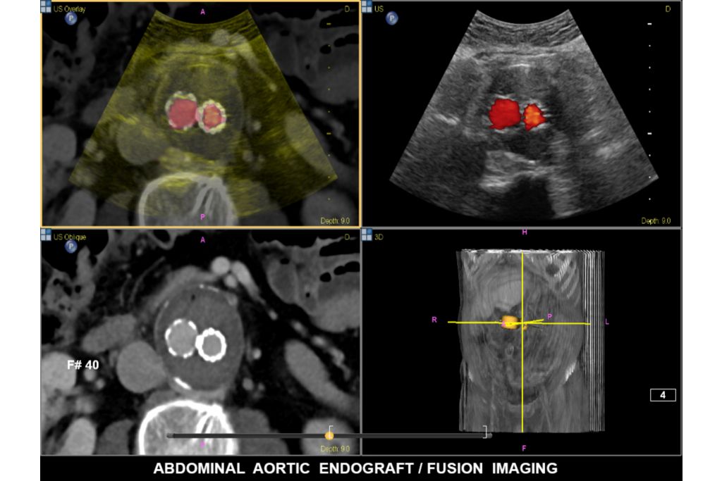Philips Fusion Image fusion and needle navigation