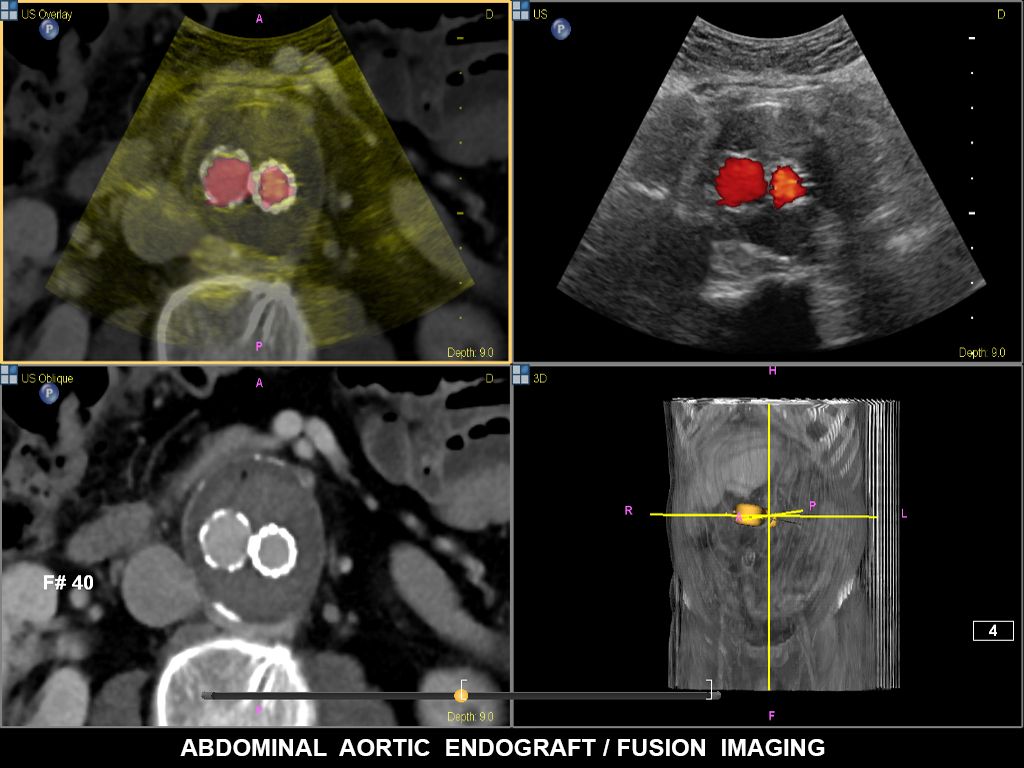 Philips Fusion Image fusion and needle navigation