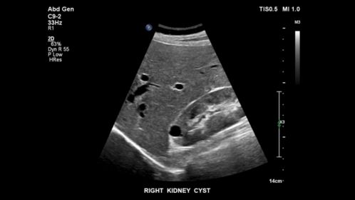 EPIQ ultrasound machine clinical image  of a right kidney cyst