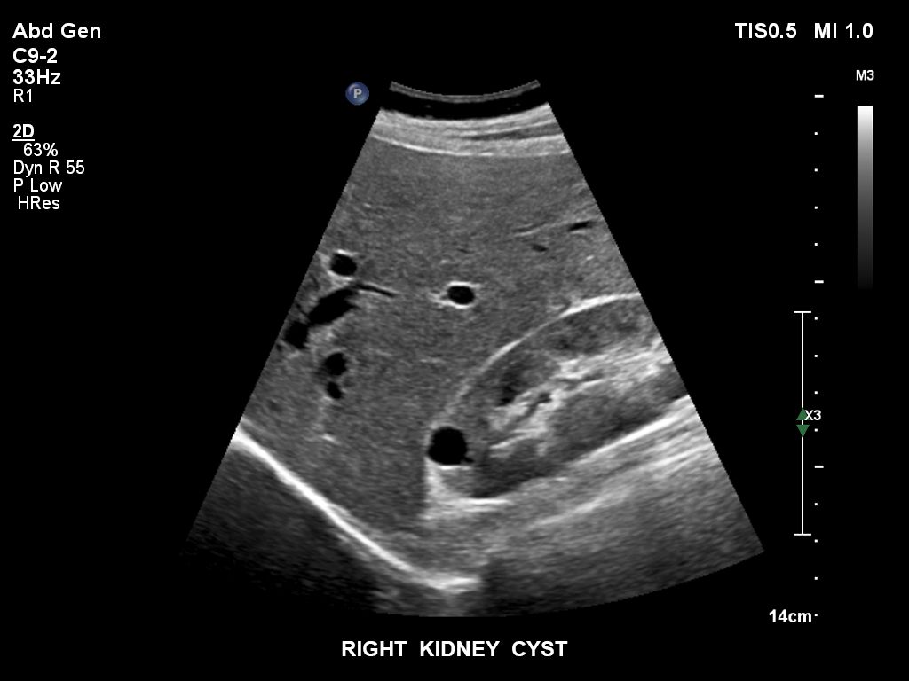 EPIQ ultrasound machine clinical image  of a right kidney cyst