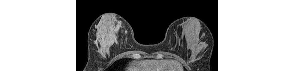 eTHRIVE - Breast
