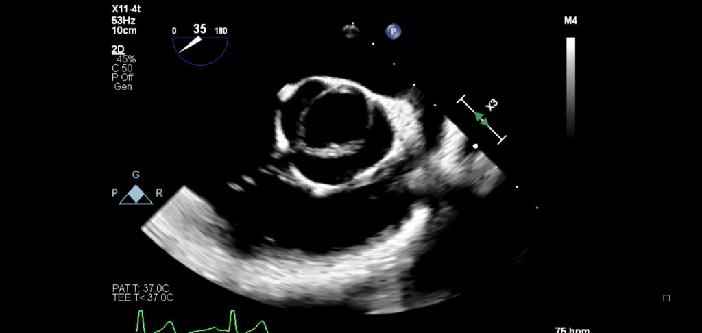X11-4t mini 3D TEE Bicuspid Aortic Valve